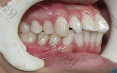 牙齿矫正可以改变凸嘴吗 矫正牙齿可以改变嘴型