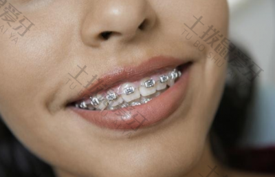 门牙五颗牙齿矫正要多少钱 牙齿可以只矫正门牙吗