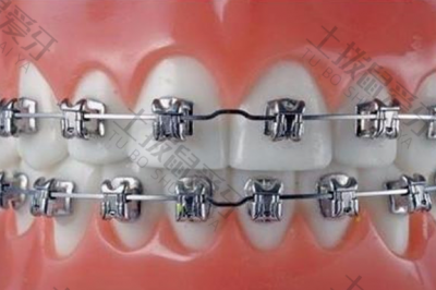 金属自锁牙套矫正工作的原理 金属自锁矫正牙套价格