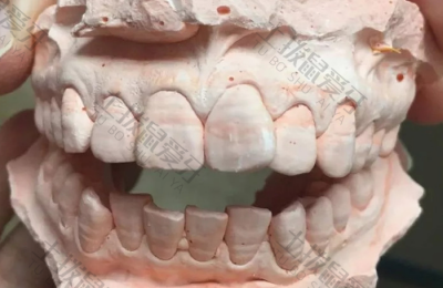 隐形牙齿矫正器价格 隐形矫正牙齿的过程 