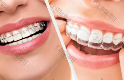 陶瓷牙套和隐形牙套哪个矫正效果快 陶瓷牙套和隐形牙套区别