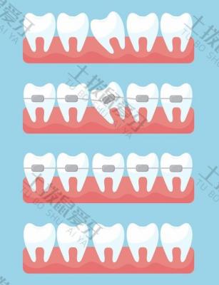 杭州儿童牙齿矫正哪里好，地包天牙齿矫正价格费用是多少？