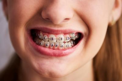 成人牙齿矫正效果好吗？有快速矫正的方法吗？
