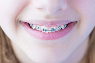 10岁男孩矫正牙齿用哪种方法比较好?儿童正畸的过程是怎么样的？