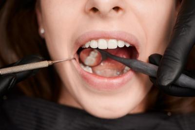 正畸为何要挂皮筋？矫正牙齿多大年龄合适？
