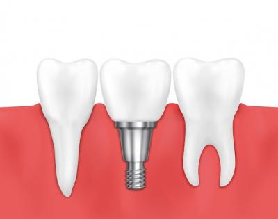 植骨粉种牙齿一颗要多少钱，种植牙填充骨粉后有何症状？