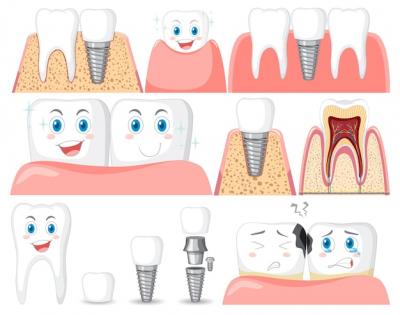 种植牙骨粉是什么材质，种植牙齿骨粉骨膜一定需要吗？