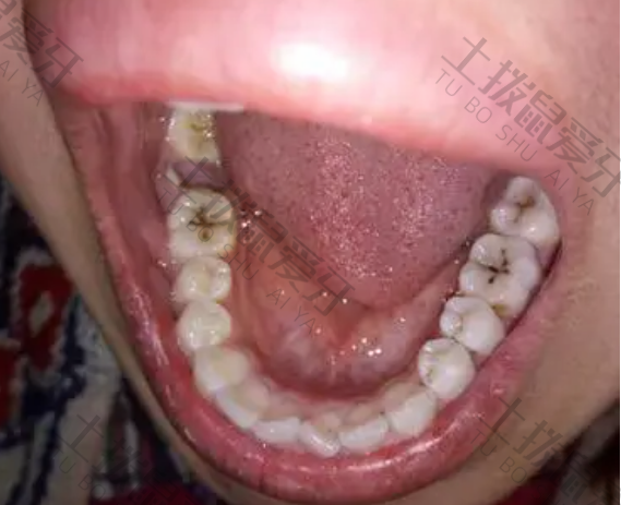 洗牙的喷头传染病吗