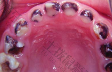 牙髓炎治疗全过程