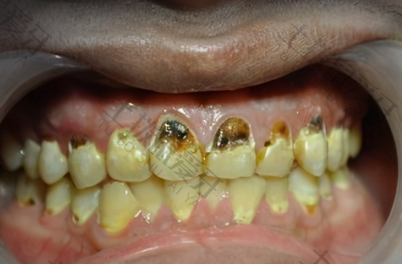 牙髓炎的症状表现
