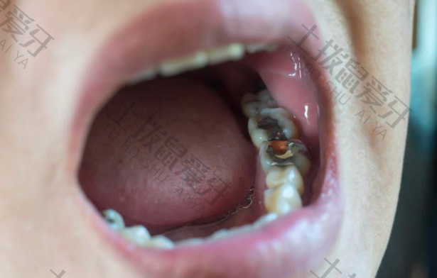 牙髓炎病因有哪些