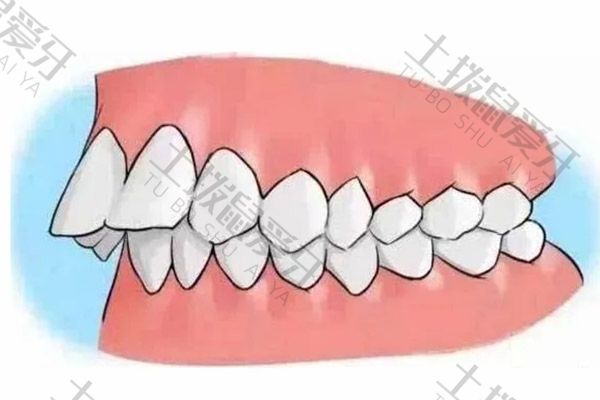 龅牙矫正牙齿价格