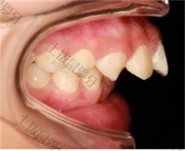 牙齿大门牙外突矫正价格