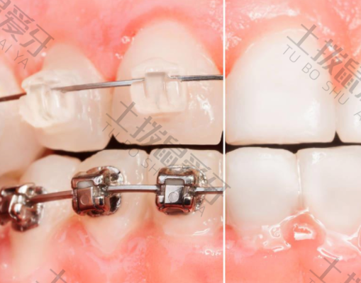 矫正牙齿和牙套价格区别