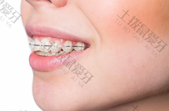 牙齿矫正分哪些种类及价格