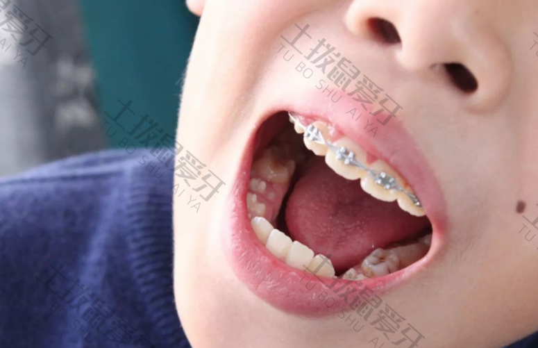 小孩牙齿反颌矫正的价格