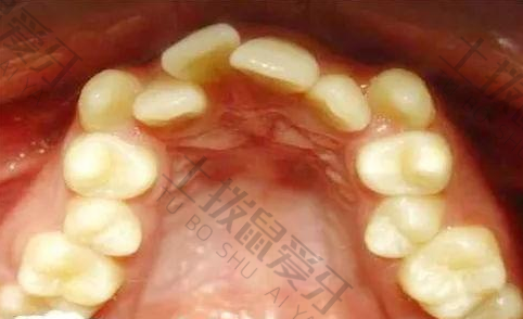 牙齿矫正器价格多少