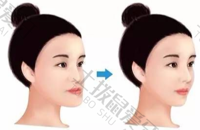 牙齿矫正硅胶价格