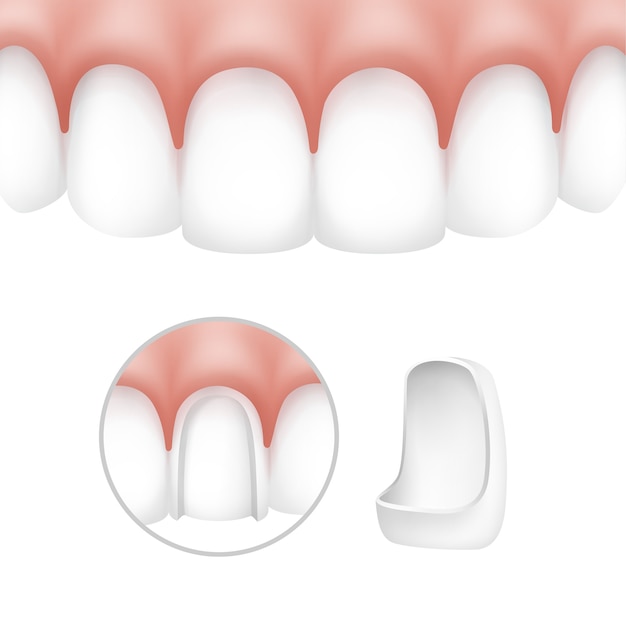 牙齿瓷贴面类型