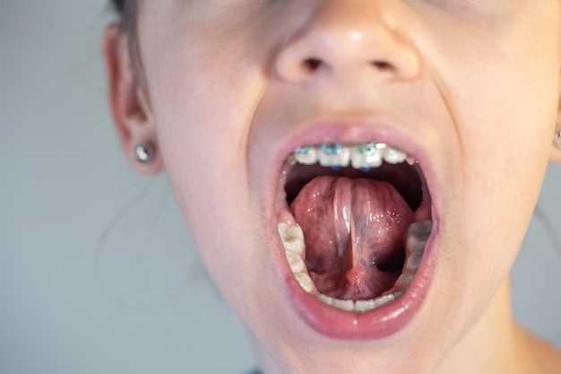 儿童矫正牙齿的注意事项