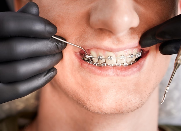 预防牙齿矫正后上牙齿向外突的措施