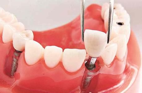 种植牙的手术过程复杂吗