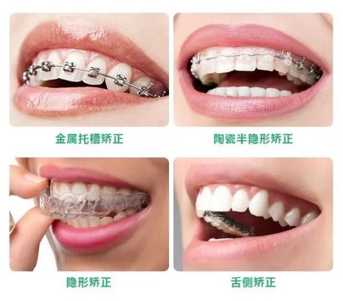 如何选择牙齿矫治器