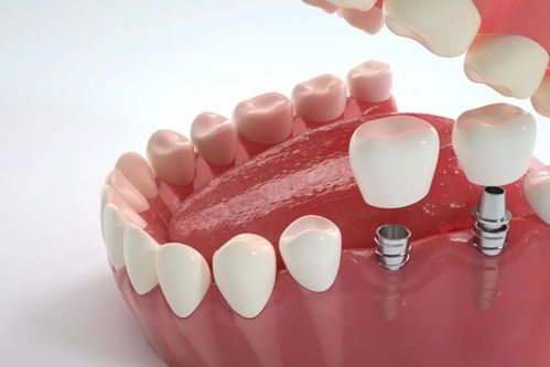 种植牙的局限性与风险