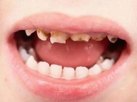 儿童龋齿的形成与危害
