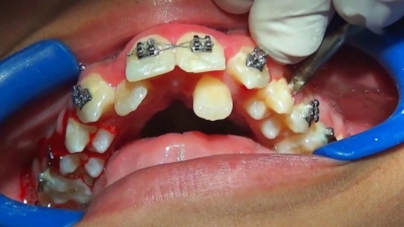 死髓牙能做牙齿矫正吗