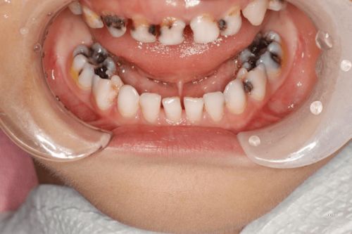 儿童容易患龋齿的原因