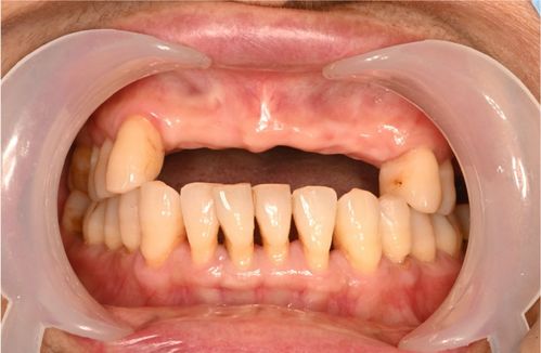 牙齿缺失的常见原因
