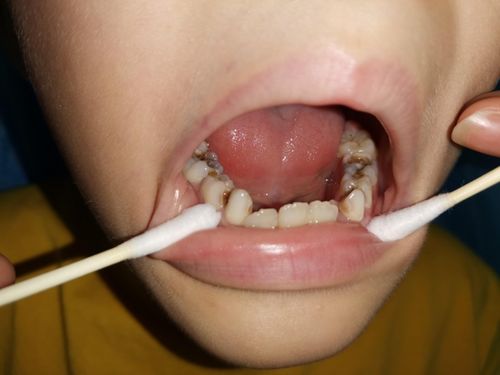 儿童补牙时的注意事项