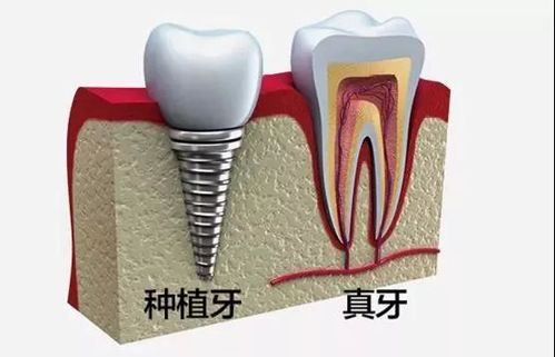 种植牙松动的解决方法