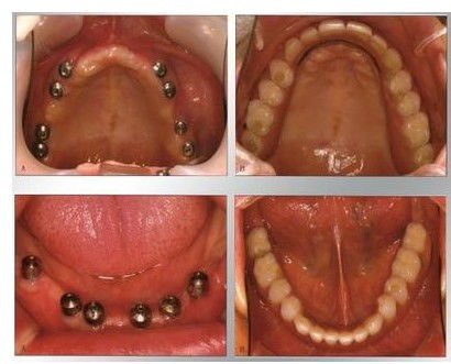 全口种植牙的不同方式