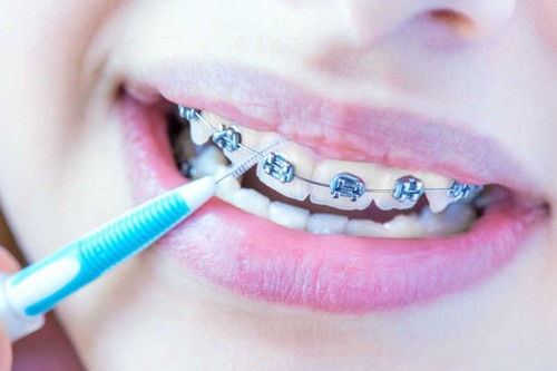 牙齿矫正改善面型的局限性