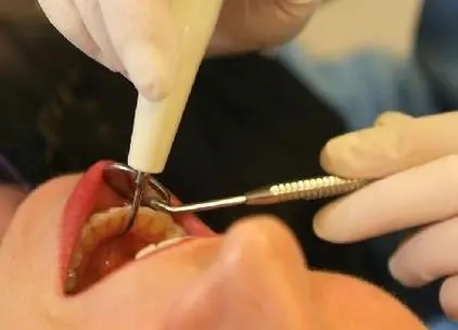 补牙与根管治疗的区别