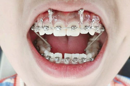 如何预防牙套脸的出现