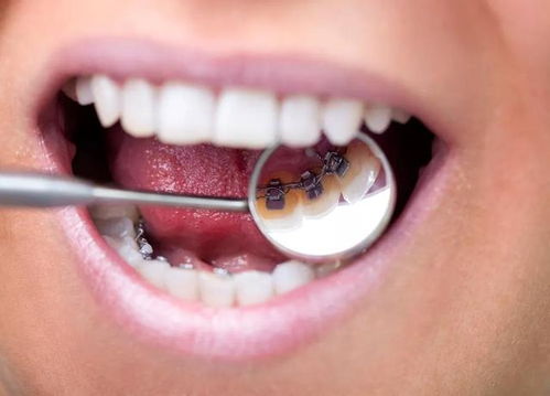 牙齿矫正中的拔牙选择