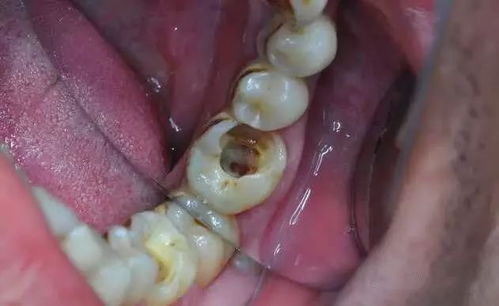 预防龋齿的方法