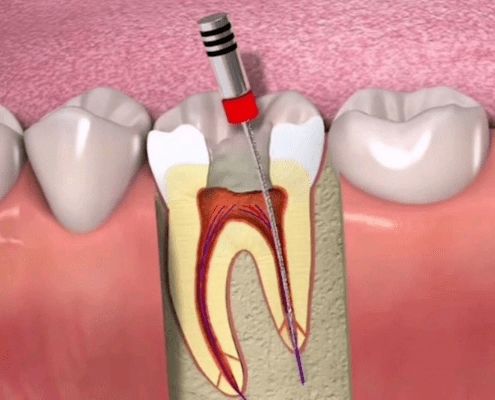 根管治疗后牙齿的使用寿命