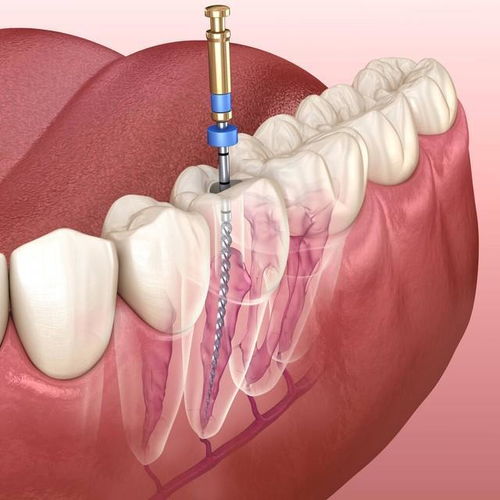 牙齿根管治疗的原理与过程