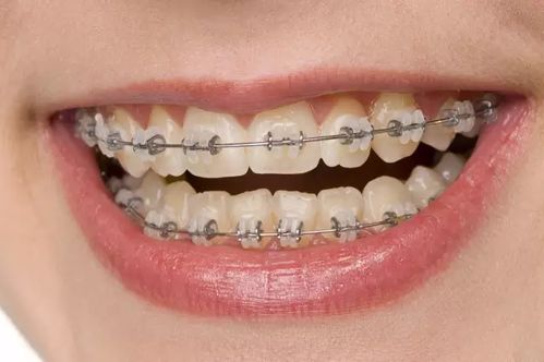 矫正牙齿与“牙套脸”的关系