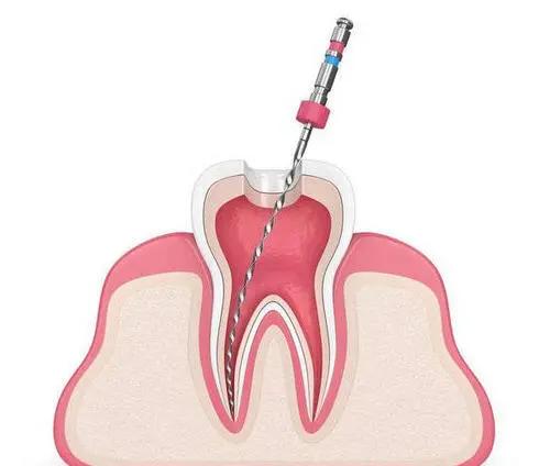 根管治疗对牙齿的影响