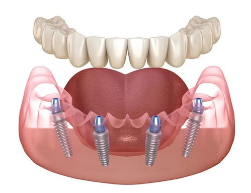口腔健康状况对种植牙成功率的间接影响