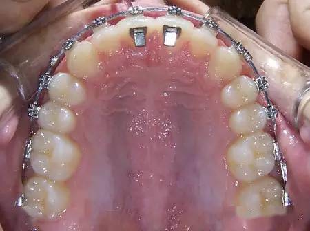 影响牙齿矫正效果的因素