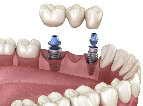 种植牙术后的日常维护方法