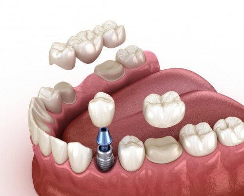 种植牙术前需要考虑的因素