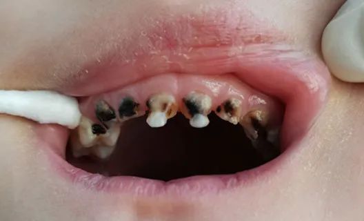 牙髓坏死的治疗和预防