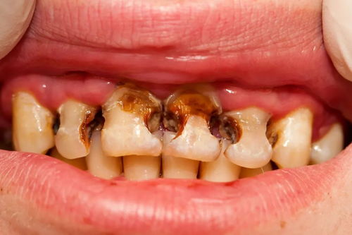 死髓牙的治疗方法